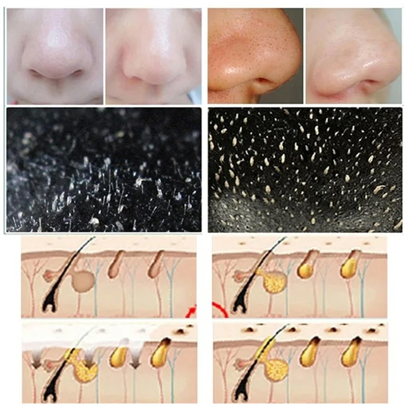 10 قطعة شرائط أنف الرؤوس السود - مراجعة Cleanser Face وسعره